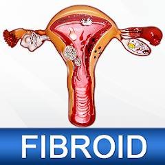 Uterine Fibroid Treatment Help