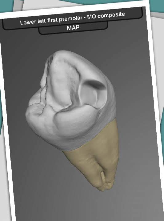 CavSim: Dental Cavity Trial screenshot 1